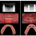 Understanding Implant-Supported Overdentures: A Comprehensive Guide